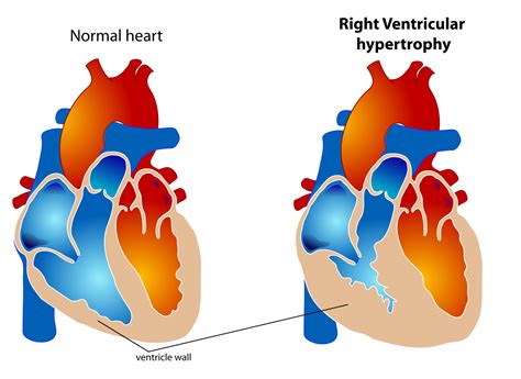 symptoms of right ventricular hypertrophy.